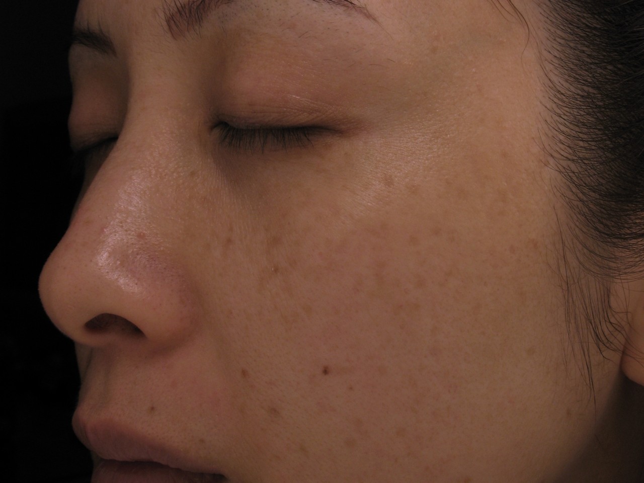 Trị nám sâu bằng Laser Toning hiệu quả có nhanh không?