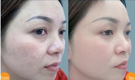 Cách chữa nám da bằng phương pháp dân gian, bạn đã thử?6