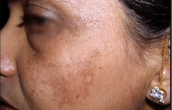 Bị nám ở quanh bọng mắt dưới có điều trị laser Toning được không?
