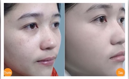 Cách chữa nám da bằng phương pháp dân gian, bạn đã thử?7
