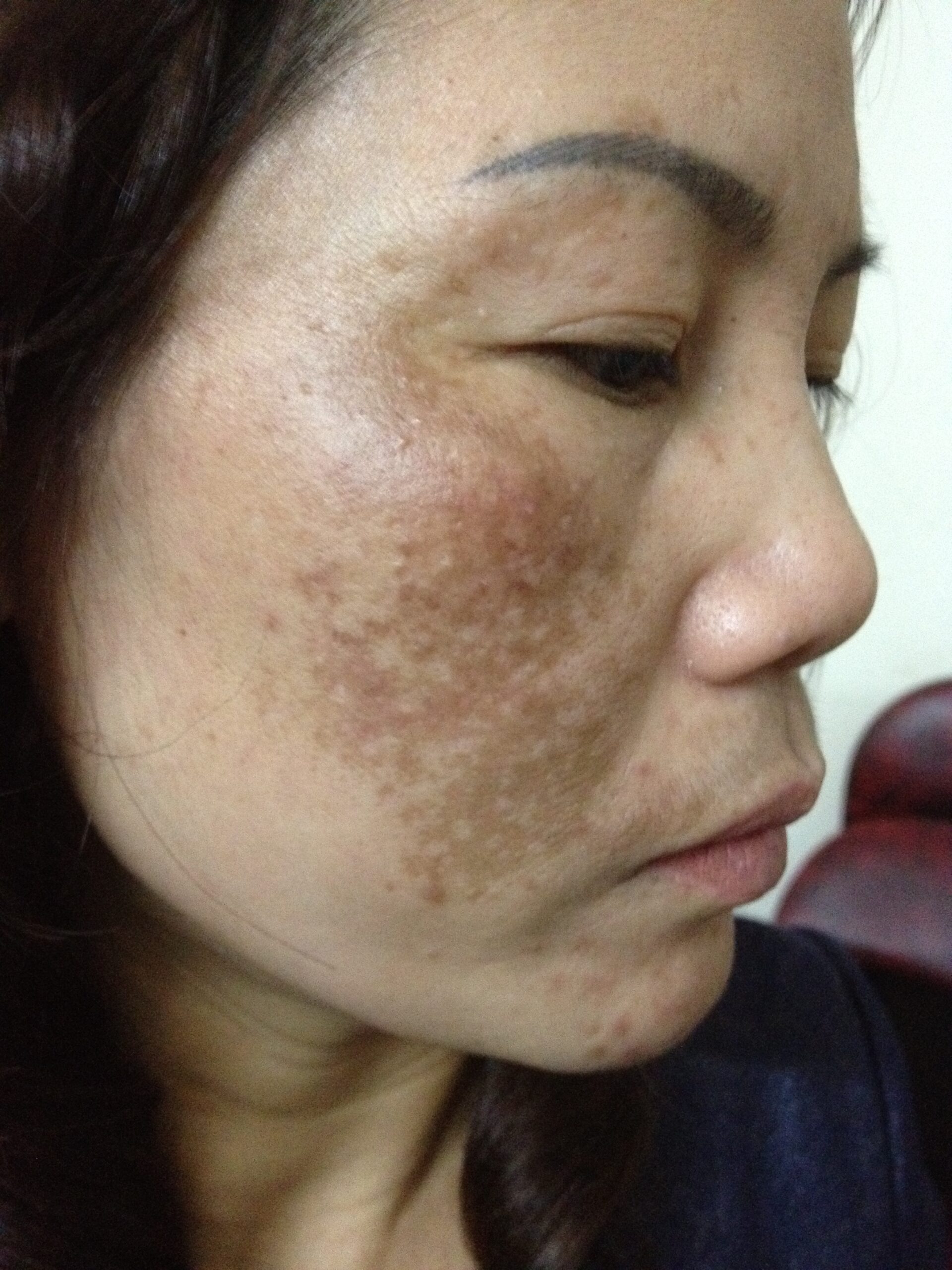 Cách chữa nám triệt để mà không lo tái phát?